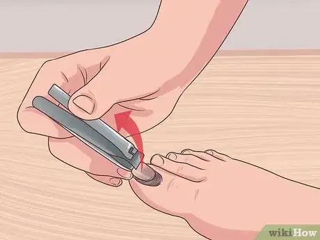 Image titled Treat a Torn Toenail Step 1