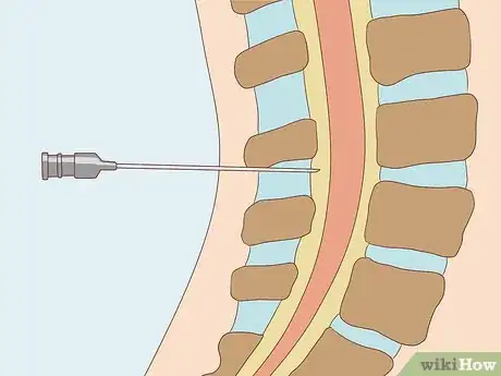 Image titled Treat Neurological Disorders Step 14