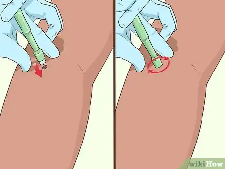 Image titled Undergo a Mole Biopsy Step 1