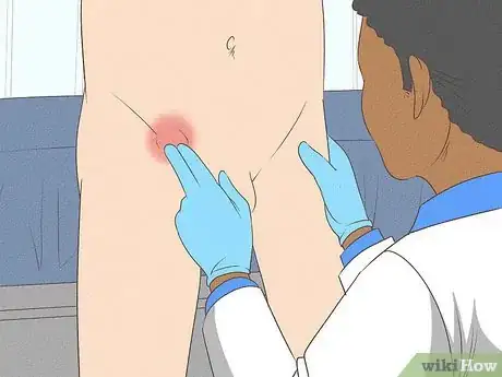 Image titled Treat Inguinal Hernia Step 7