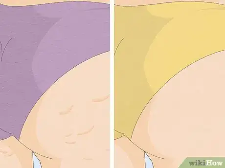 Image titled Get Rid of Cellulite With Exercise Step 1