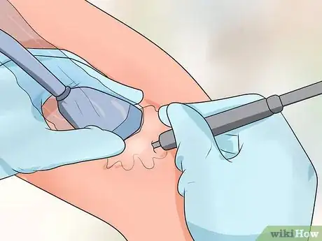 Image titled Alleviate Tendonitis Step 28