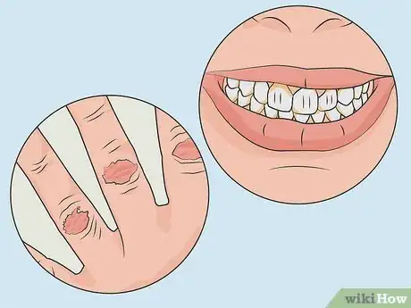 Image titled Diagnose and Treat Purging Disorder Step 01