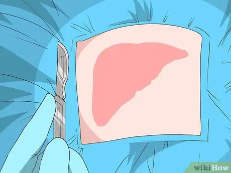 Image titled Treat Liver Disease Step 17