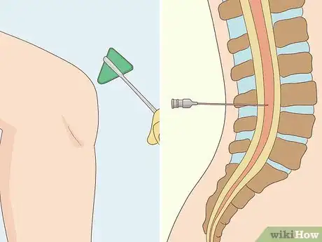 Image titled Treat Neurological Disorders Step 12