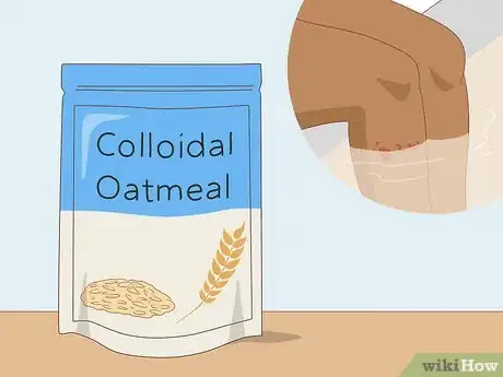 Image titled Soothe Itchy Legs Step 19