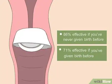 Image titled Use a Cervical Cap Step 1