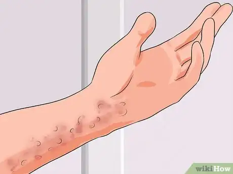 Image titled Recognize and Treat Dengue Fever Step 5