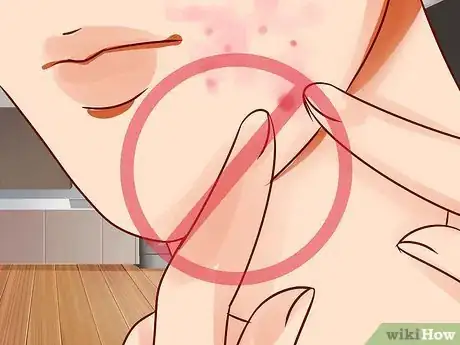 Image titled Get Rid of a Hard Pimple Step 19