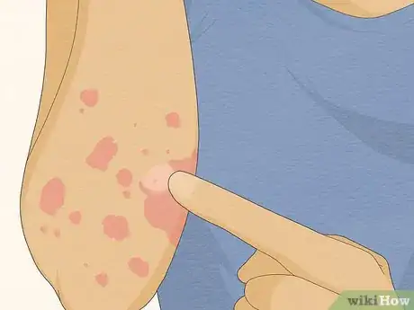 Image titled Recognize Hives (Rash) Step 3