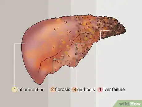 Image titled Diagnose Liver Fibrosis Step 13