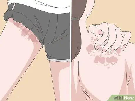 Image titled Avoid Triggers for Chronic Hives Step 5
