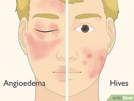 Image titled Recognize Hives (Rash) Step 4