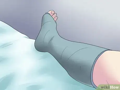 Image titled Treat a Broken Ankle Step 14