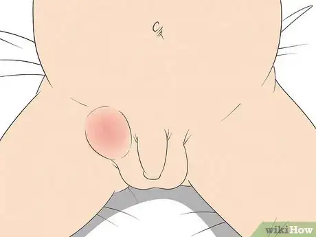 Image titled Treat Inguinal Hernia Step 4