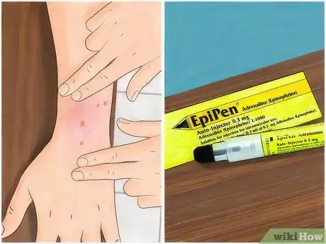 Image titled Identify Fire Ant Stings Step 8