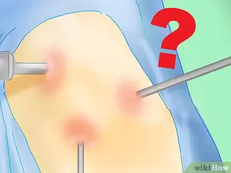 Image titled Prevent Bruising After Plastic Surgery Step 3