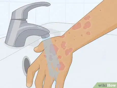 Image titled Recognize Hives (Rash) Step 9