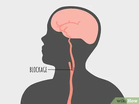 Image titled Treat Atherosclerosis Step 10