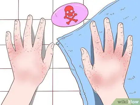 Image titled Handle an Eczema Flare Up Step 2