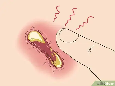 Image titled Know if a Wound Is Healing Step 3