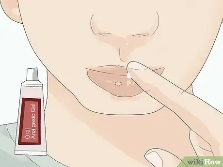 Image titled Soothe Mouth Ulcers in Toddlers Step 5