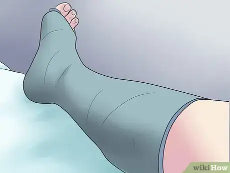 Image titled Treat a Broken Ankle Step 22