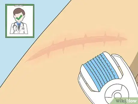 Image titled Buy a Dermaroller Step 4