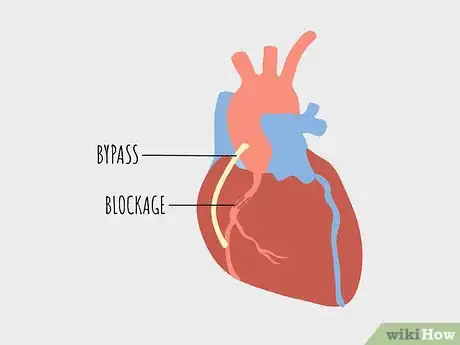 Image titled Treat Atherosclerosis Step 11