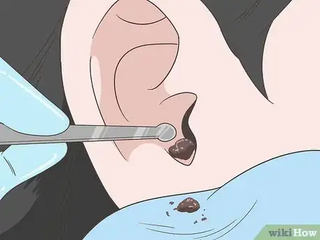 Image titled Prevent Cerumen Impaction Step 10