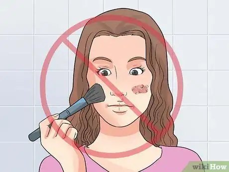 Image titled Clear Mild Acne Fast Step 8