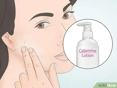 Image titled Clear Pustules on Your Face Step 7
