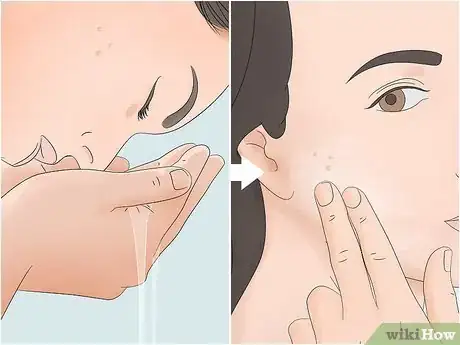 Image titled Clear Pustules on Your Face Step 2