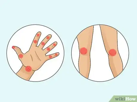 Image titled Diagnose Rheumatoid Arthritis Step 2