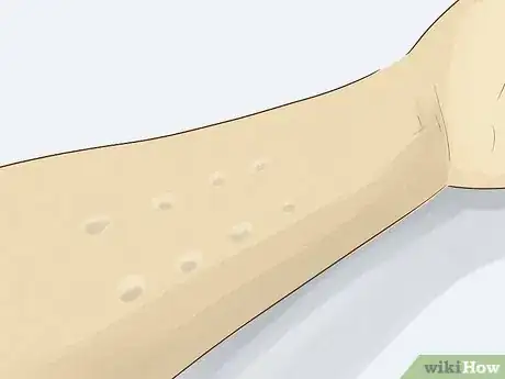 Image titled Get Tested for Allergies Step 7