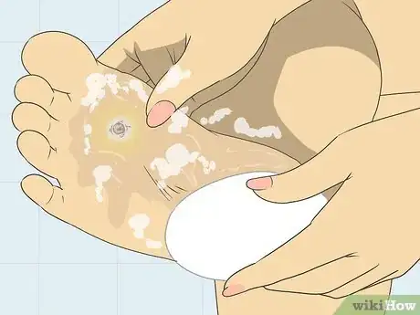 Image titled Freeze Plantar Warts Step 11