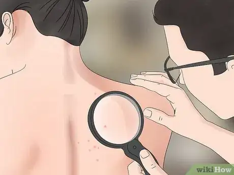 Image titled Treat Sand Flea Bites Step 9