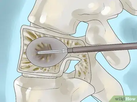 Image titled Treat Compression Fractures with Back Surgery Step 4