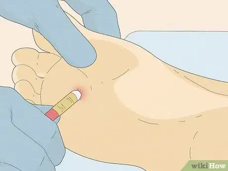 Image titled Know if You Have Neuropathy in Your Feet Step 8