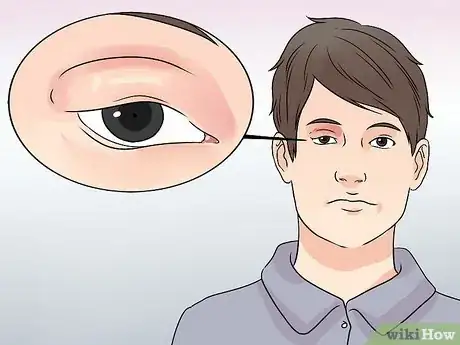 Image titled Diagnose Pink Eye Step 1