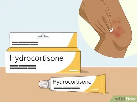 Image titled Soothe Itchy Legs Step 20