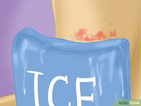 Image titled Prevent Hives Step 4