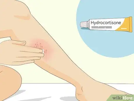 Image titled Soothe Itchy Legs Step 23