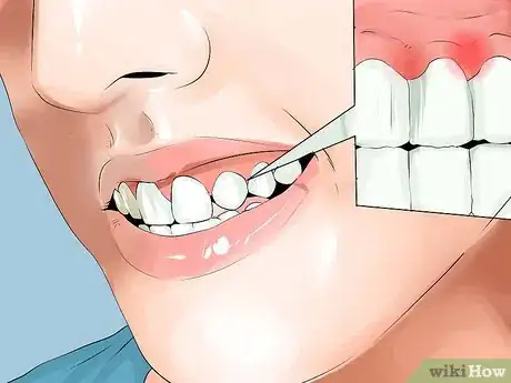 Image titled Identify if You Have Sensitive Teeth Step 8