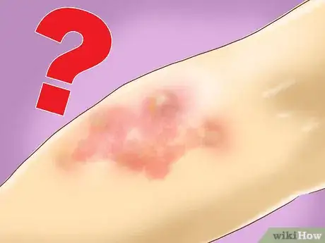 Image titled Treat Vibration Induced Hives Step 6