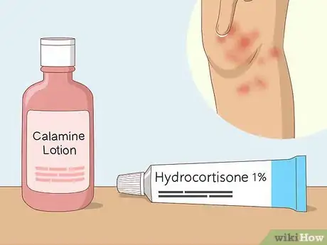 Image titled Soothe Itchy Legs Step 27