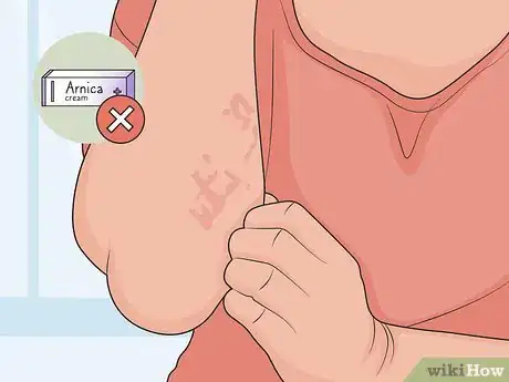Image titled Use Arnica for Natural Remedies Step 08
