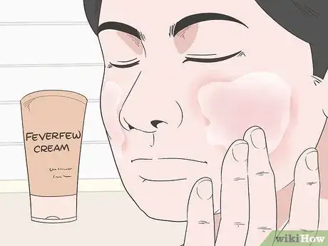 Image titled How to Treat Rosacea Can Herbal Remedies Help Step 7