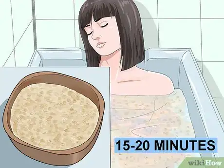 Image titled Treat Erythrodermic Psoriasis Step 5