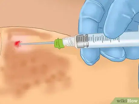 Image titled Diagnose Typhoid Fever Step 5